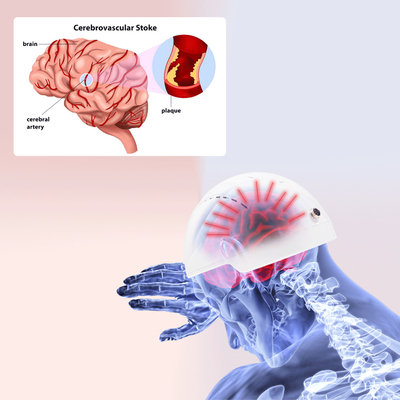 Casco médico de la fisioterapia de lesión de Brain Rehabilition Infrared Transcrial Neuron para la invitación de la depresión