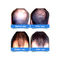 Casquillos del crecimiento del pelo del laser del diodo 5mW de la clase II para la pérdida de pelo